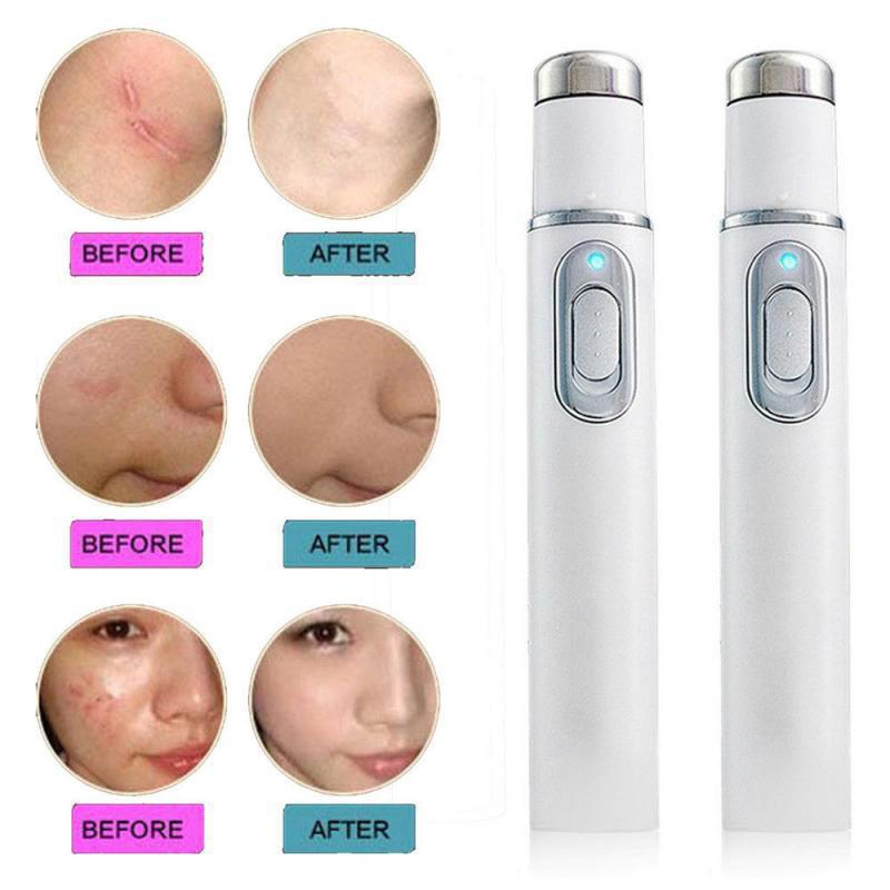 🔥🏆Blue Light Acne Treatment Pen | Fast Clear Stubborn Pimples & Blemishes🔥