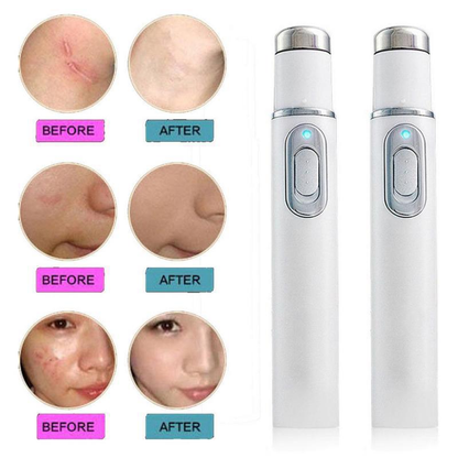 🔥🏆Blue Light Acne Treatment Pen | Fast Clear Stubborn Pimples & Blemishes🔥